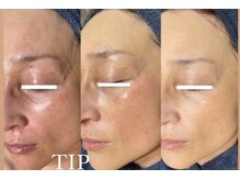 ダリア(Dahlia)/剥離ありハーブピーリング