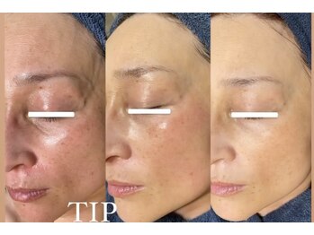 ダリア(Dahlia)/剥離ありハーブピーリング