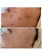 リリーガーデン(Lily Garden)/繰り返す大人ニキビを終わらせる