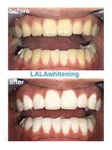 ララホワイトニング/Before&After強力ホワイトニング