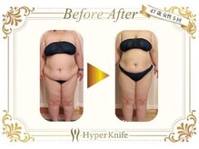 カワイ ビューティーサロン 新宿西口店(Kawai Beauty Salon)/【ハイパーナイフ】before/after