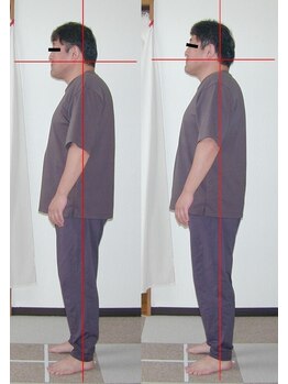 ピュアリー整療院/施術前後（横）