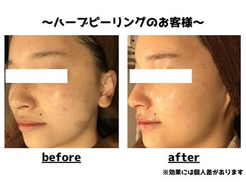 トータルビューティーみつとも/ハーブピーリング