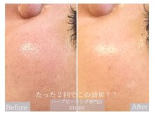 ストーリー 沼津店(STORY)/ハーブピーリング専門店STORY