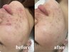 【繰り返すぶつぶつ肌荒れを撲滅】プレミアムケア◎REVIハーブピーリング