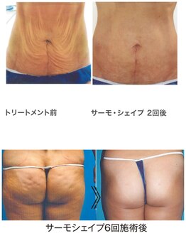 エムプリュ 心斎橋店(M.plus)/痩せてもたるまない。ハリ爆誕！