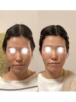 小顔22 ボルティ 赤坂支店(Bolty)/【面長＝中顔面】の印象が変化