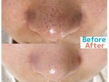 パルテール/W毛穴洗浄で毛穴ツルツル★