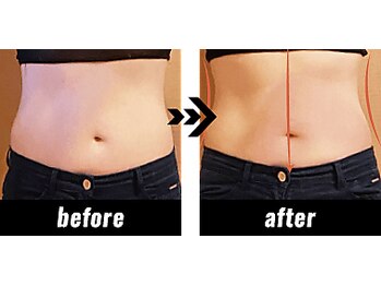 ココ センガ ビューティー クリニック(COCO SENGA Beauty-Clinic)/ラジオ波・キャビ・吸引のマシン