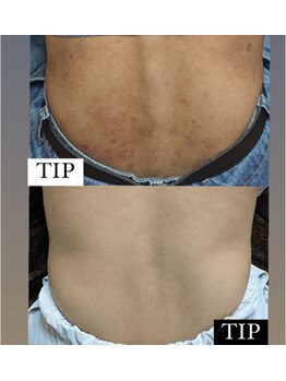 ムーンリズム(Moonlism)/【TIPハーブ症例】