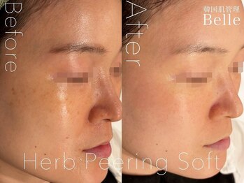 ベル 戸塚(Belle)/ハーブピーリング｜ニキビケア