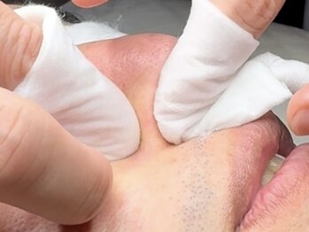 サラグランデ(Sara Grande)/男性毛穴エクストラクション