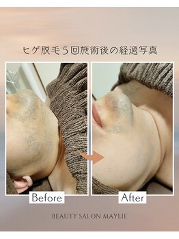 メイリー(Maylie)/ヒゲ脱毛経過写真