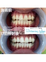 ホワイトニングサロン 福岡天神店/ホワイトニング