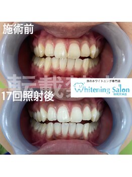 ホワイトニングサロン 福岡天神店/ホワイトニング