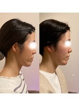 小顔22 ボルティ 赤坂支店(Bolty)/【面長＝中顔面】が改善