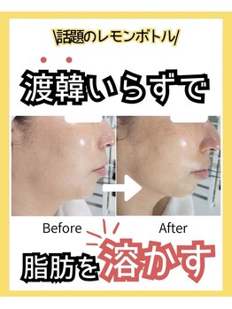 グラシア(gracia)の写真/【エステ版ポテンツァ×レモンボトル】渡韓せずに本場の施術を浦添で☆驚きの変化にリピーター続出！