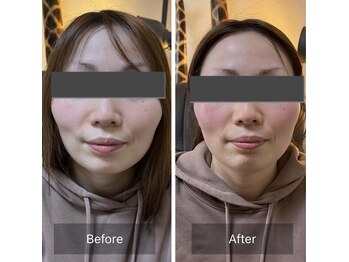 リノリー(rinory)/小顔矯正