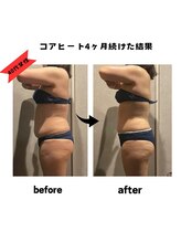 エクラ(ECLAT)/コアヒート痩身