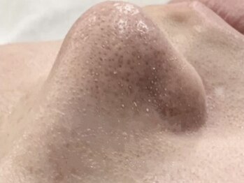 アンノウン 姫路店(Unknown.)の写真/【ハイドロピーリング毛穴洗浄】話題の毛穴ピーリングで透明感UP◎毛穴の黒ずみ・ごわつき・いちご鼻に♪