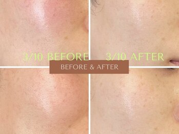 リラクゼーションサロン ラキ(laki)/トロイピール/ハーブピーリング