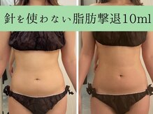 ソルニス(Solnis.)/痩身☆脂肪分解/ハイパーナイフ