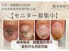 栃木県初【再発させない深爪矯正】即日見た目改善¥23100→モニター価格¥12900