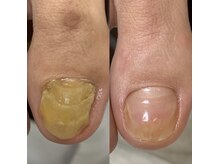 ランカ(RUNKA)/変色爪もお任せ下さい！