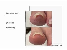 フット巻き爪補強