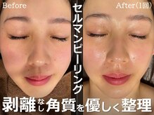 セレブリボーン 大阪ボーテの雰囲気(セルマンピーリング/剥離なし/肌、本来の【美肌維持力】を再生)