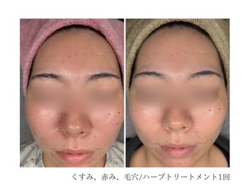 ルーム(room)/ハーブトリートメント1回