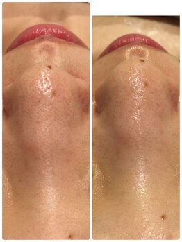 ディア(DiA)の写真/《毛穴の黒ずみ・開き・しみ・シワ・たるみ改善に！》お肌のお悩みに合わせて施術内容をカスタマイズ♪