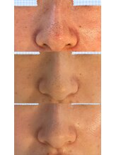 ムニ(muniii)/Before/After