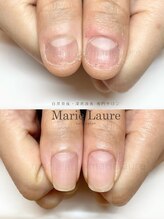 マリーロール 梅田店(Marie Laure)/深爪矯正/自爪育成/自爪風