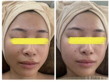 マスカレード(Masquerade)/プラピール症例写真