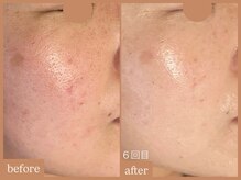 リムーン 岡崎(Re'moon)/REVI ハーブピーリング