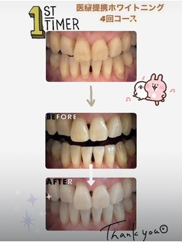 ハチ(HACHI)/医療提携ホワイトニング４回