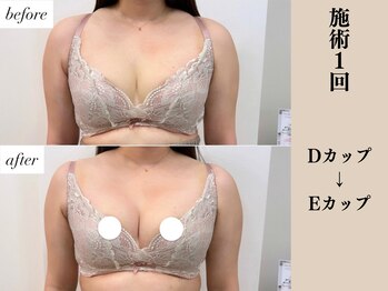 ソワ(soie)/一度でもふわふわデコルテに変身