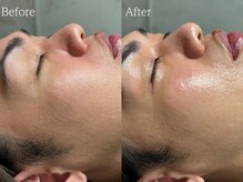 ルミナ シブヤ(LUMINA SHIBUYA)/【ダクトピール】1回目　横顔