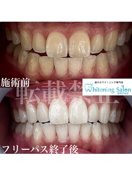 ホワイトニングサロン 福岡天神店/ホワイトニング