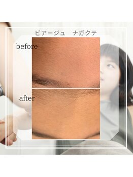 ビアージュ ナガクテ(Beage nagakute)/キッズ脱毛　顔