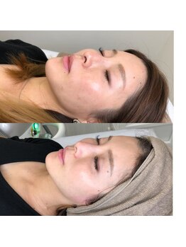ラブル(Rubble)/beforeafter