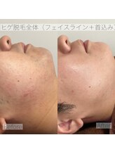 エステティックサロンR/ヒゲを無くして清潔感２倍！