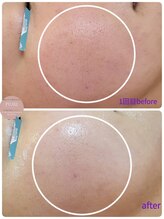 ピウリ(PIURI)/Before→After 毛穴の黒ずみ改善