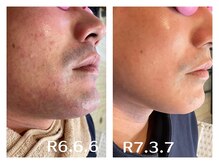 フィズ 五日市彩が丘店(FIS)/☆before/after☆都度払い