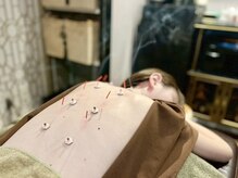 リラ鍼灸接骨院(Rela鍼灸接骨院)/美容しんきゅう