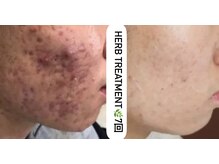 ミミルーチェ(mimiluce)/ニキビにはハーブピーリング