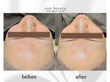 アン ビューティー(ann beauty)/施術1回【症例写真】