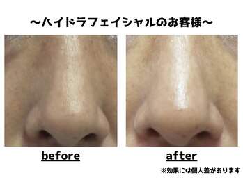 トータルビューティーみつとも/毛穴洗浄/ハイドラフェイシャル