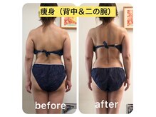 ルクール(Le Couer)の雰囲気（背中・二の腕コースのビフォーアフターです★）